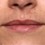 Lip Filler Before & After Patient #31921