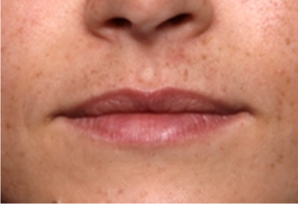 Lip Filler Before & After Patient #31921