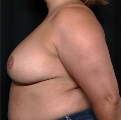 Breast Reduction Before & After Patient #31984
