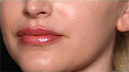 Lip Filler Before & After Patient #31960