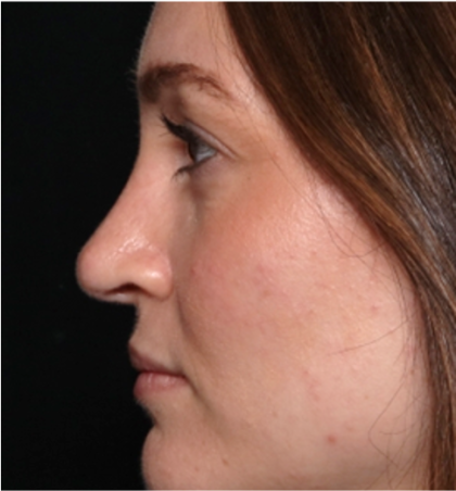 Rhinoplasty Before & After Patient #31934