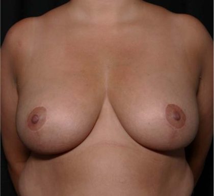 Breast Reduction Before & After Patient #31984