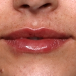 Lip Filler Before & After Patient #31921