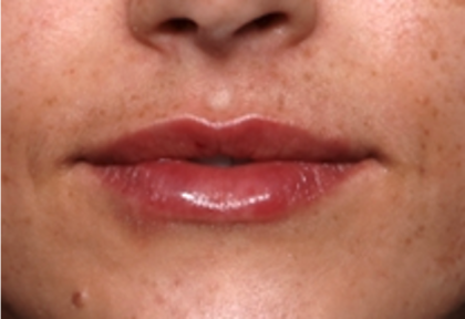 Lip Filler Before & After Patient #31921
