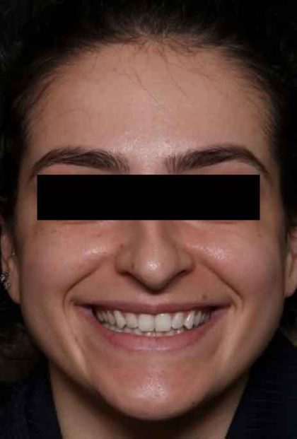 Botox and Dysport Before & After Patient #31894