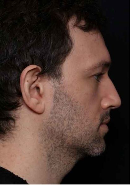 Kybella Before & After Patient #31906