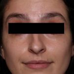 Botox and Dysport Before & After Patient #31894