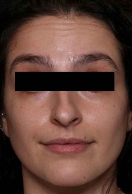 Botox and Dysport Before & After Patient #31894