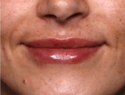 Lip Filler Before & After Patient #31921