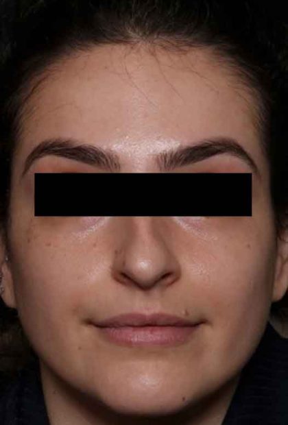 Botox and Dysport Before & After Patient #31894