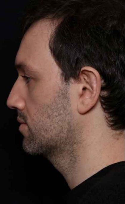 Kybella Before & After Patient #31906