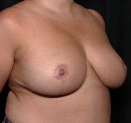 Breast Reduction Before & After Patient #31984