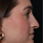 Rhinoplasty Before & After Patient #31934