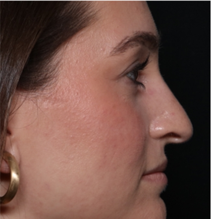 Rhinoplasty Before & After Patient #31934