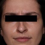 Botox and Dysport Before & After Patient #31894