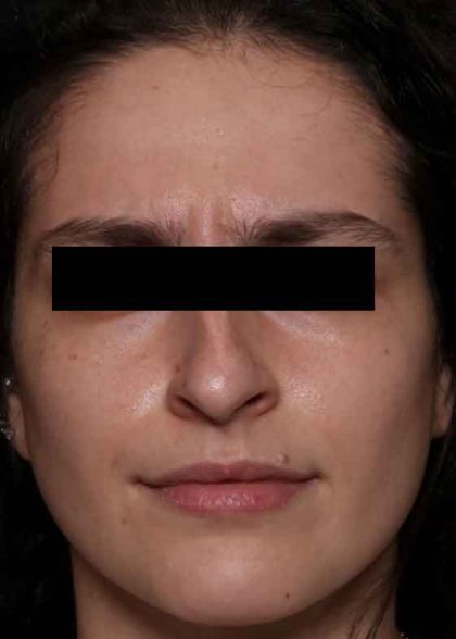 Botox and Dysport Before & After Patient #31894