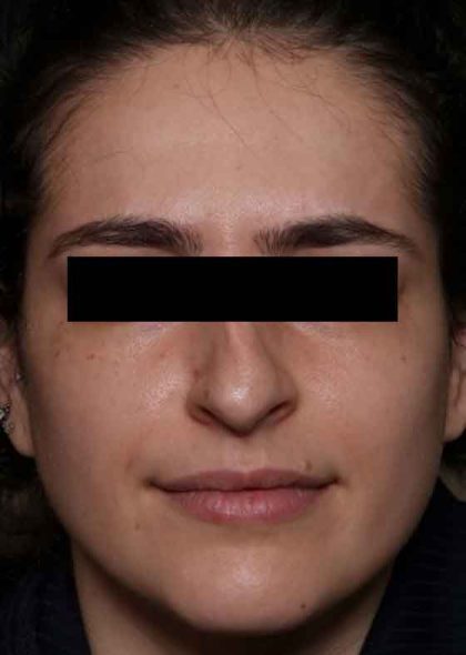 Botox and Dysport Before & After Patient #31894