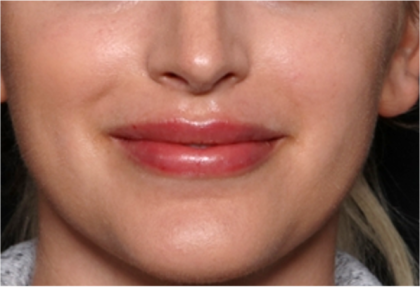 Lip Filler Before & After Patient #31960