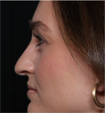 Rhinoplasty Before & After Patient #31934