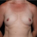 Breast Augmentation - Round Silicone Implants Before & After Patient #31996