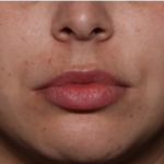 Lip Filler Before & After Patient #32070