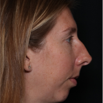 Rhinoplasty Before & After Patient #32113