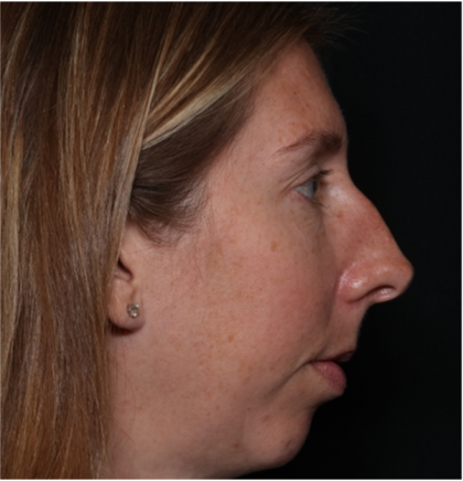 Rhinoplasty Before & After Patient #32113