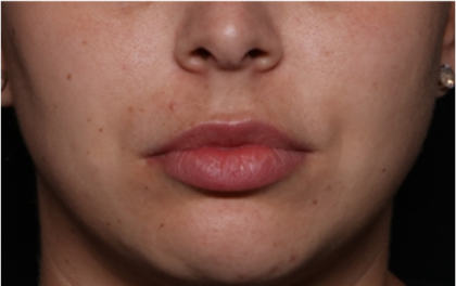 Lip Filler Before & After Patient #32070