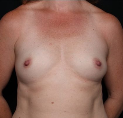 Breast Augmentation - Round Silicone Implants Before & After Patient #31996