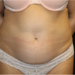 Tummy Tuck Before & After Patient #32133