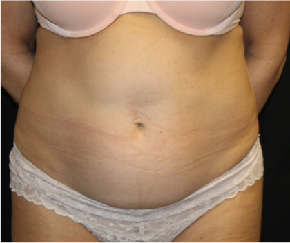 Tummy Tuck Before & After Patient #32133