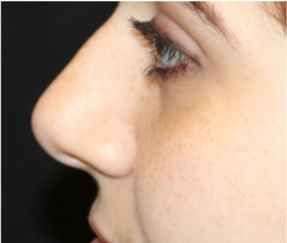 Rhinoplasty Before & After Patient #32144