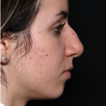 Rhinoplasty Before & After Patient #32157