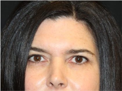 Brow Lift Before & After Patient #32100