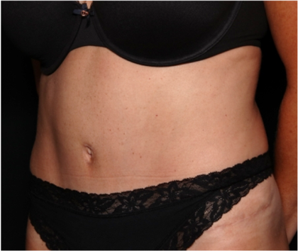 Tummy Tuck Before & After Patient #32133