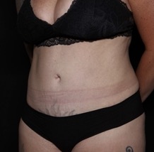 Tummy Tuck Before & After Patient #32087