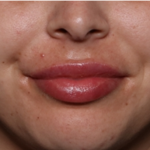 Lip Filler Before & After Patient #32070