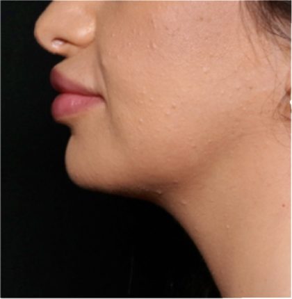Injectable Fillers Before & After Patient #32008