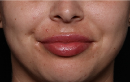 Lip Filler Before & After Patient #32070