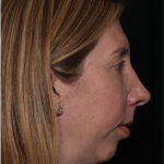 Rhinoplasty Before & After Patient #32113