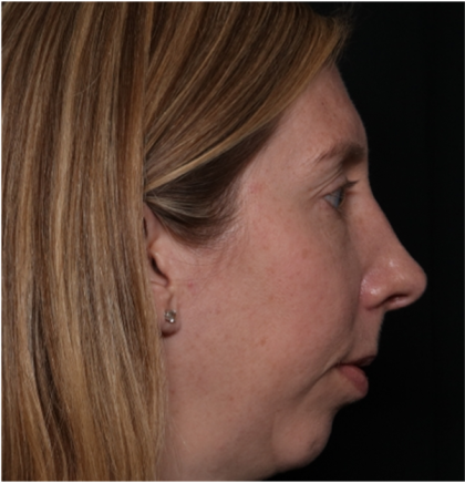 Rhinoplasty Before & After Patient #32113