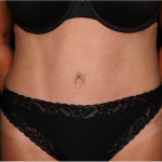 Tummy Tuck Before & After Patient #32133