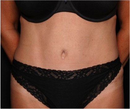 Tummy Tuck Before & After Patient #32133