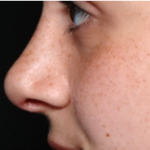 Rhinoplasty Before & After Patient #32144