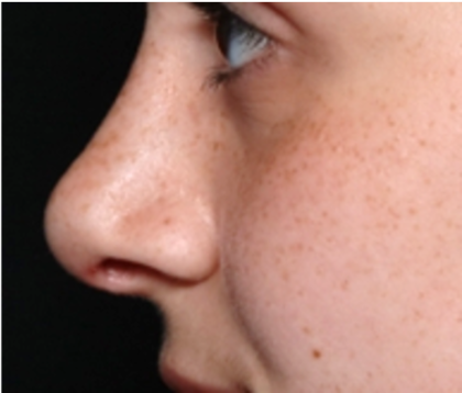 Rhinoplasty Before & After Patient #32144