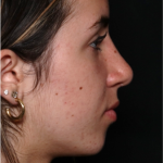 Rhinoplasty Before & After Patient #32157