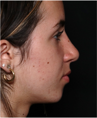 Rhinoplasty Before & After Patient #32157