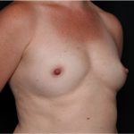 Breast Augmentation - Round Silicone Implants Before & After Patient #31996