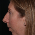 Rhinoplasty Before & After Patient #32113