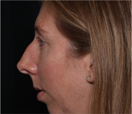 Rhinoplasty Before & After Patient #32113